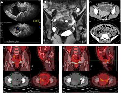 Case report: NUT carcinoma with MXI1::NUTM1 fusion characterized by abdominopelvic lesions and ovarian masses in a middle-aged female